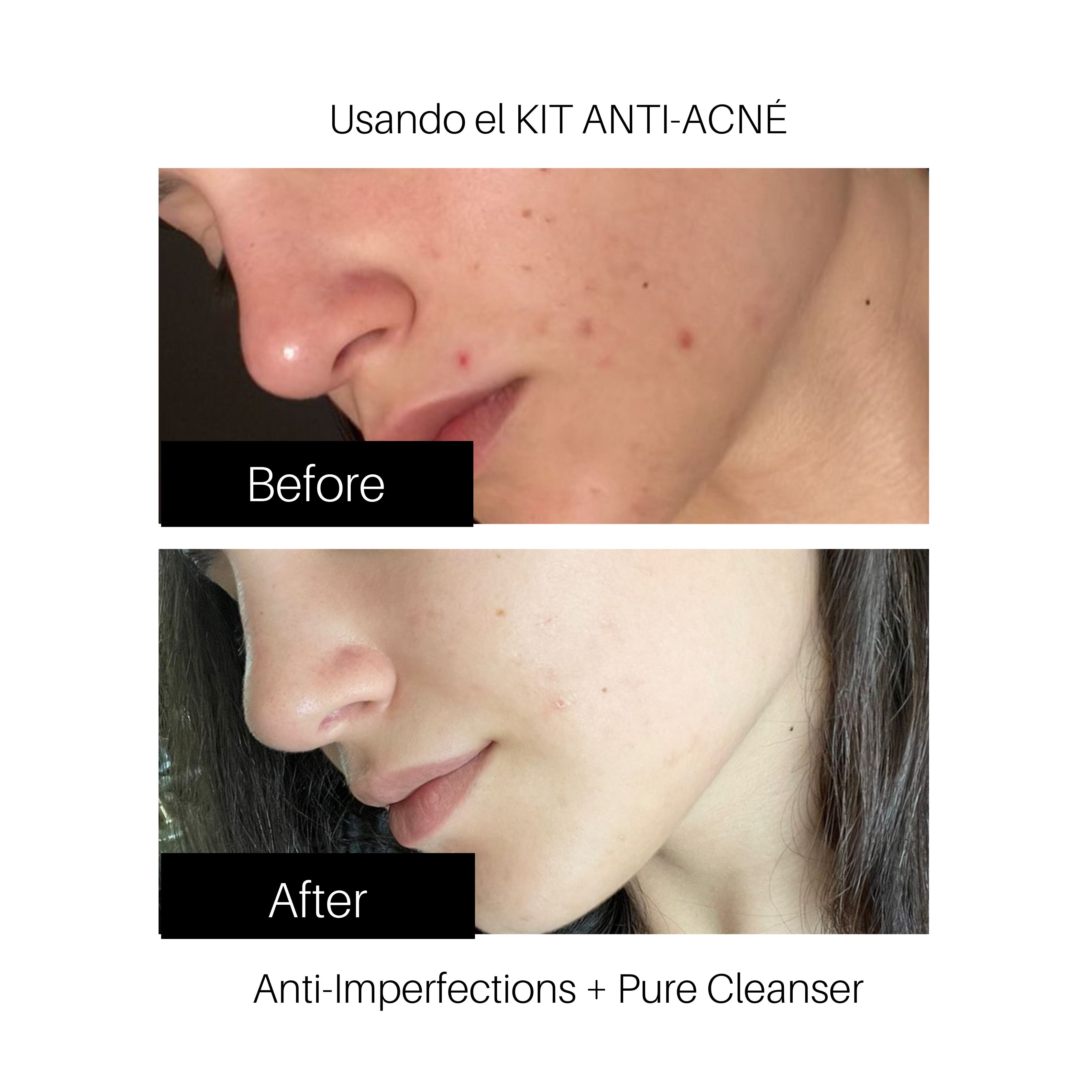 ANTI-ACNE KIT